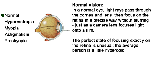 refractive errors