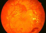 A retina with advanced diabetic retinopathy