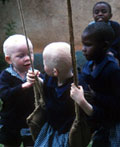 People with albinism have pale or white skin and hair 