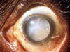 Severe cataract