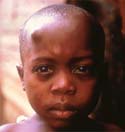 The nodule on this child's head is filled with filarial worms